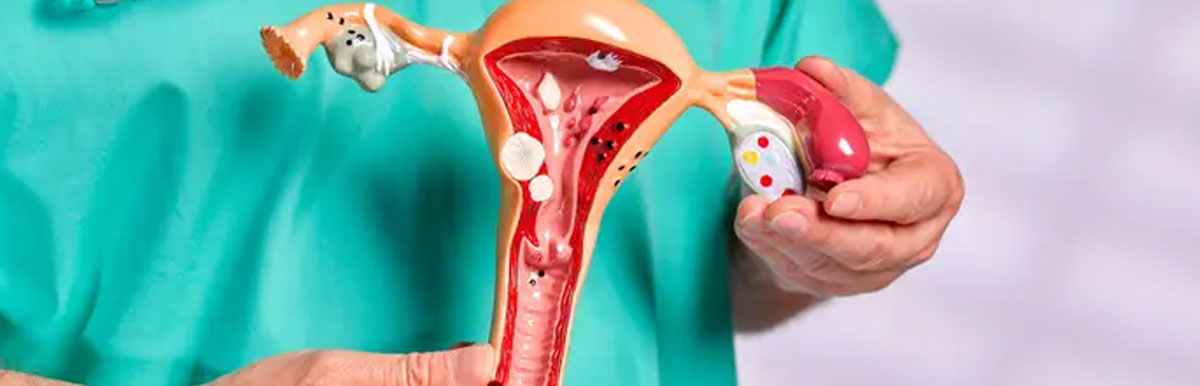 Fibroids Treatment